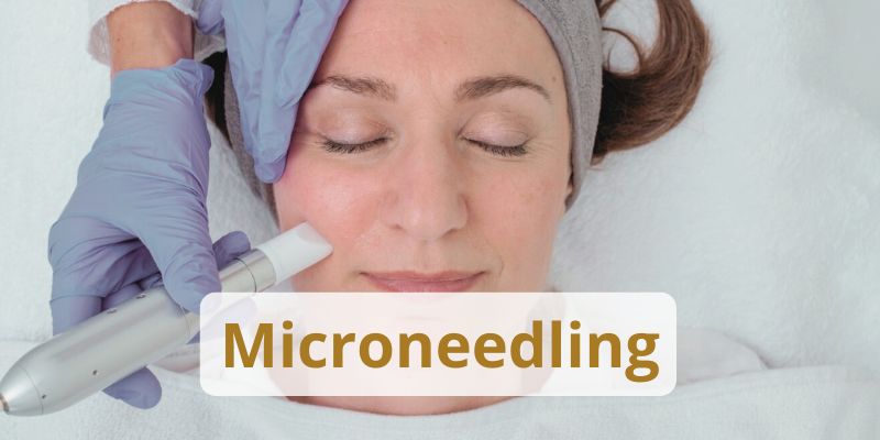 Kundin bei Microneedling Behandlung